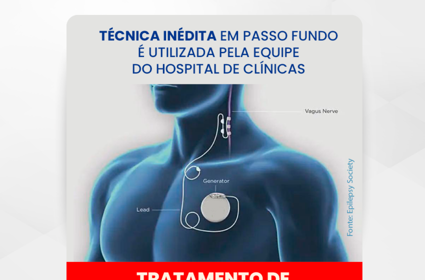 Técnica inédita em Passo Fundo é utilizada pela equipe do Hospital de Clínicas para tratamento de epilepsia refratária